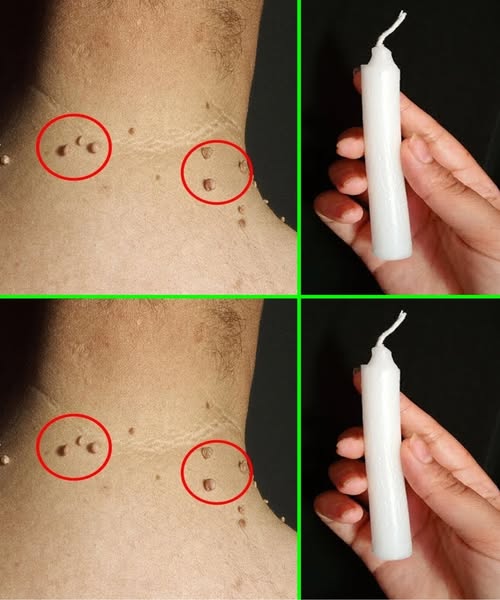 🔥 Remove Skin Tags in Just 3 Days Using One Candle! – The Fast, Natural Remedy Everyone’s Talking About 🔥