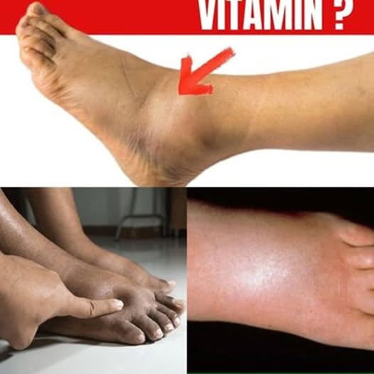 The No.1 Vitamin for Removing Leg and Foot Swelling Fast – What You Must Know!