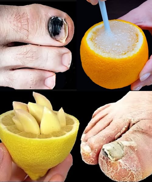 Treat Toenail Fungus for Less Than $1 – Wipe It Away Like an Eraser!