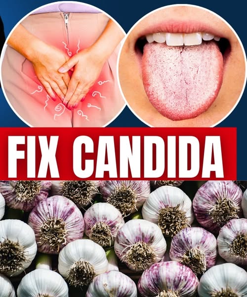 Say Goodbye to Candida: 8 Natural Remedies That Help Cure It for Good