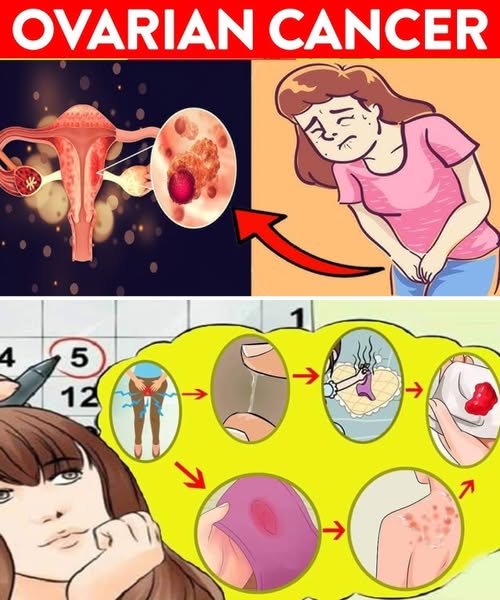 9 Common Ovarian Cancer Signs You Should Never Ignore: Early Detection Could Save Your Life